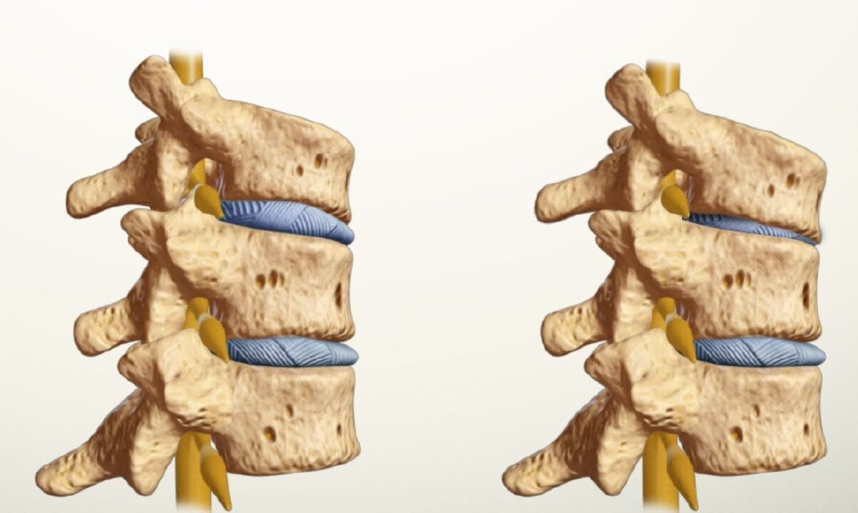 Qual tratamento é eficaz para a osteocondrose da coluna lombar? - Hondrogel